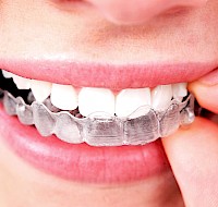 Maintaining Your Post-Invisible Aligner Smile